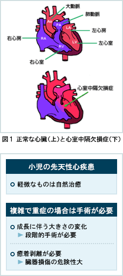 図1 正常な心臓（上）と心室中隔欠損症（下）／小児の先天性心疾患／複雑で重症の場合は手術が必要