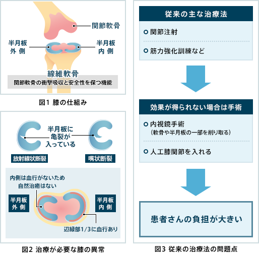 図1 膝の仕組み／図2 治療が必要な膝の異常／図3 従来の治療法の問題点