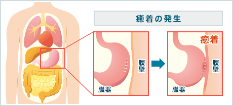 癒着の発生