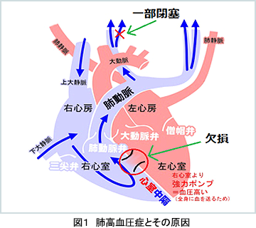 図１ 肺高血圧とその原因