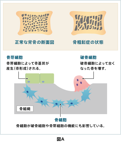 骨に作用する メディカルポリマーの開発 人にやさしい 患部に届く 診断 治療の非侵襲化 スマート化を実現するメディカルポリマー 研究紹介 関西大学 人に届く 関大メディカルポリマーによる未来医療の創出