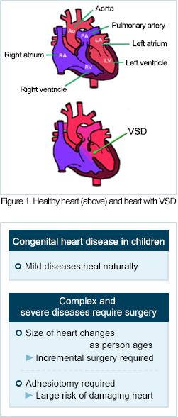 Figure 1 Normal heart (upper) and ventricular septal defect (lower) / Congenital congenital heart disease / Surgery is necessary for complex and severe cases