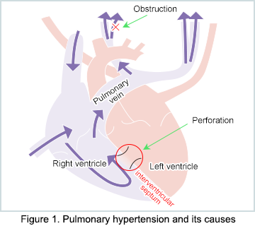 Fig. 1 Pulmonary hypertension and its causes
