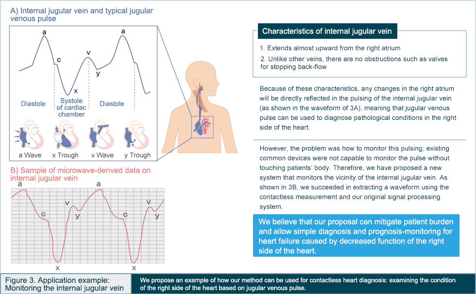  Application example for intravenous monitor in Fig. 3